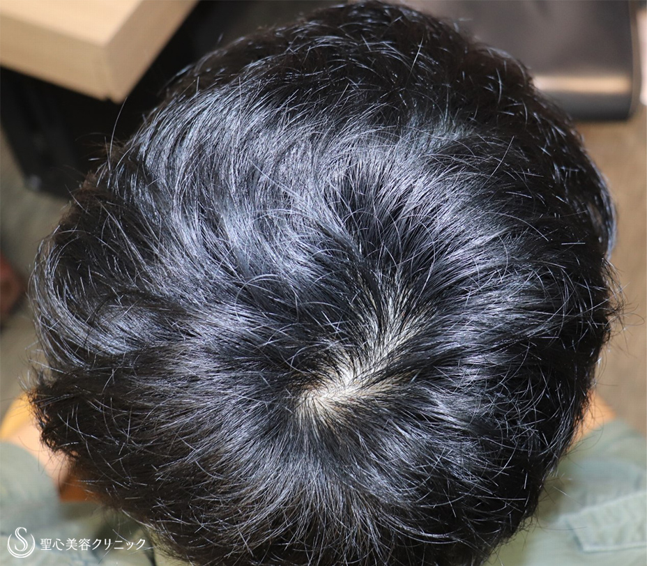 【20代男性・髪の毛の悩みは王道コースで解決】プレミアムグロースファクター再生療法＋アボルブ・ミノキシジル内服（半年後） After 