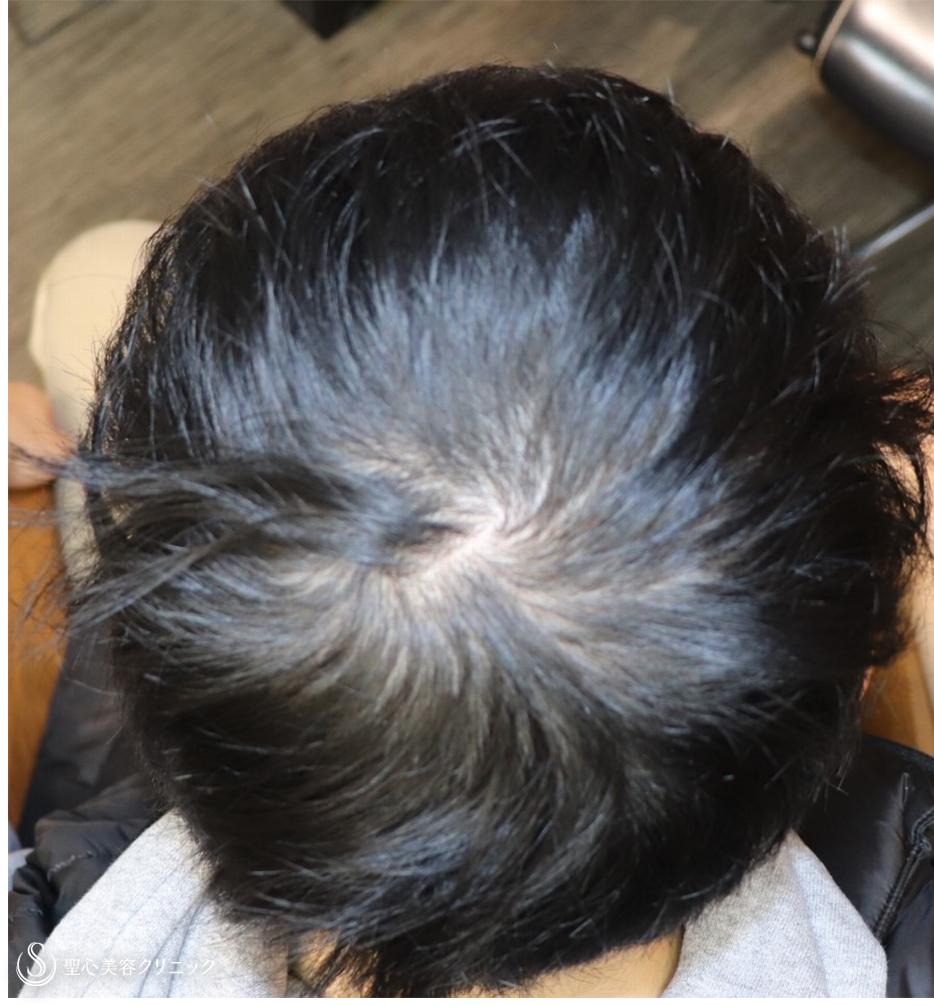 【20代男性・髪の毛の悩みは王道コースで解決】プレミアムグロースファクター再生療法＋アボルブ・ミノキシジル内服（半年後） Before 
