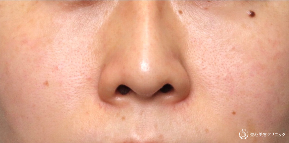 【30代女性・鼻の穴を目立たせない】鼻孔縁下降術（術後1週間） Before 
