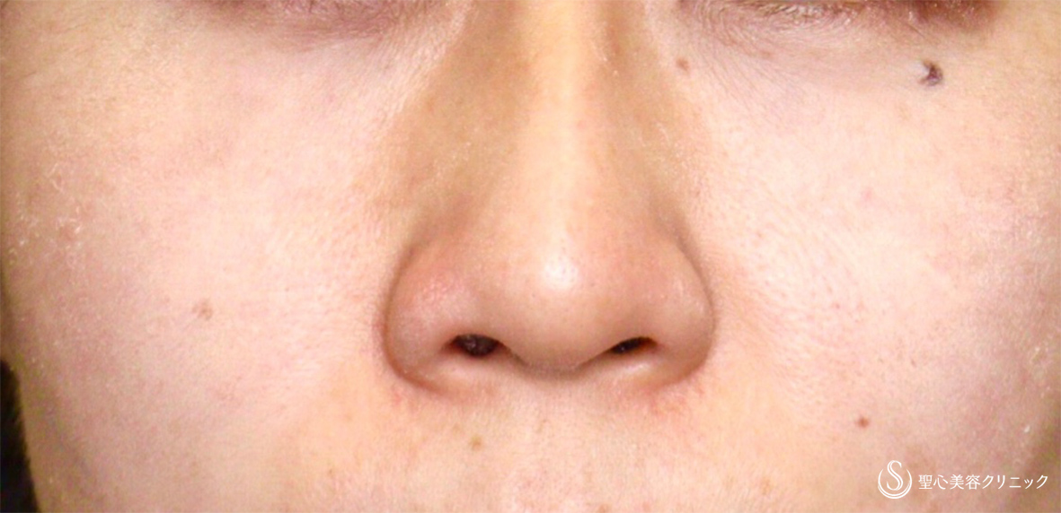 【30代女性・鼻の穴を目立たせない】鼻孔縁下降術（術後1週間） After 