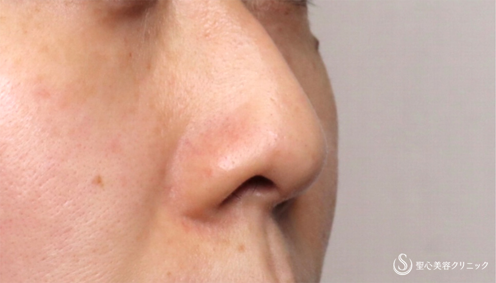 【30代女性・鼻の穴を目立たせない】鼻孔縁下降術（術後1週間） Before 