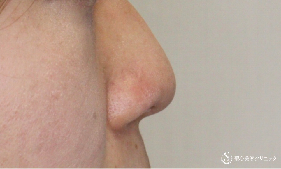 【30代女性・鼻の穴を目立たせない】鼻孔縁下降術（術後1週間） After 