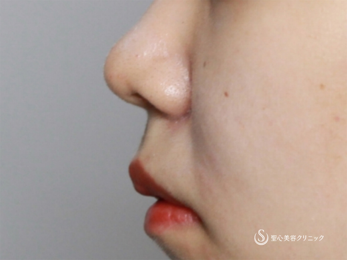 【20代女性・鼻先の割れの修正】鼻尖縮小+３DPCLドーム（1ヶ月後） After 