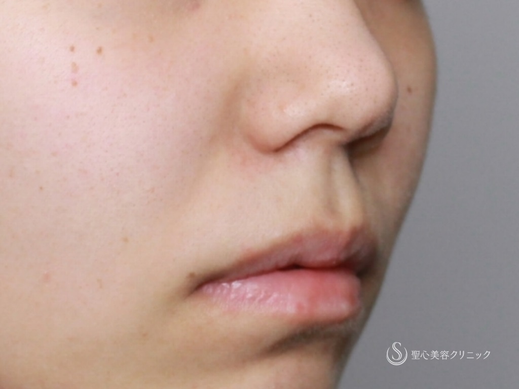 【20代女性・鼻先の割れの修正】鼻尖縮小+３DPCLドーム（1ヶ月後） Before 