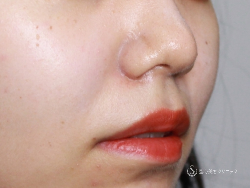【20代女性・鼻先の割れの修正】鼻尖縮小+３DPCLドーム（1ヶ月後） After 