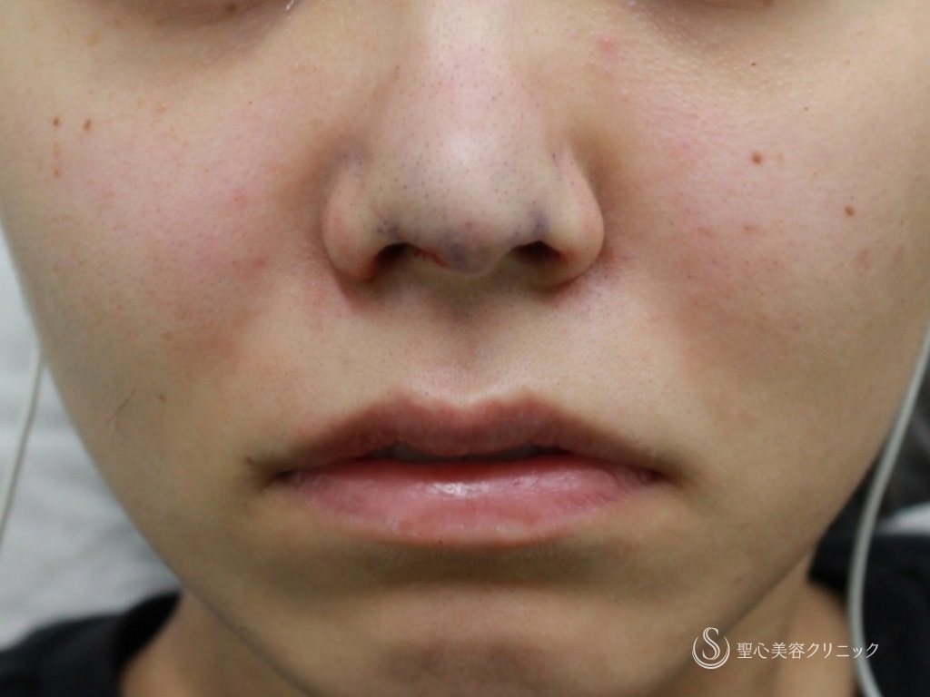 【20代女性・鼻先の割れの修正】鼻尖縮小+３DPCLドーム（1ヶ月後） Before 
