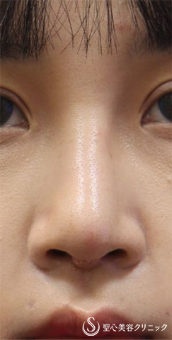 【女性・鼻の修正】3Dオーダーメイドプロテーゼによる修正（術後１週間） After 