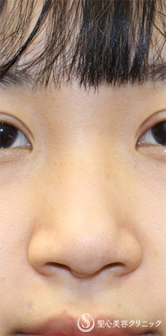 【女性・鼻の修正】3Dオーダーメイドプロテーゼによる修正（術後１週間） Before 