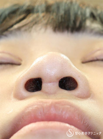 【女性・鼻の修正】3Dオーダーメイドプロテーゼによる修正（術後１週間） Before 