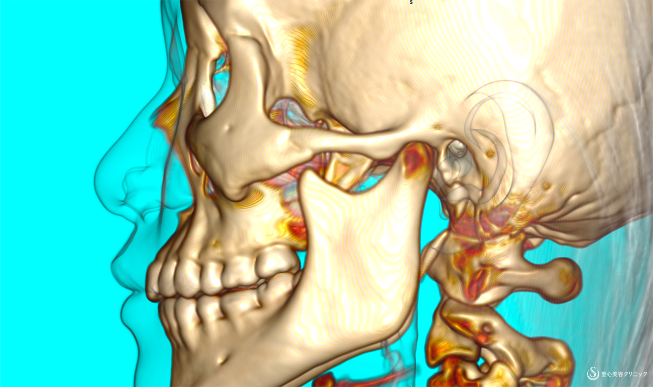 【女性・鼻の修正】3Dオーダーメイドプロテーゼによる修正（術後１週間） Before 