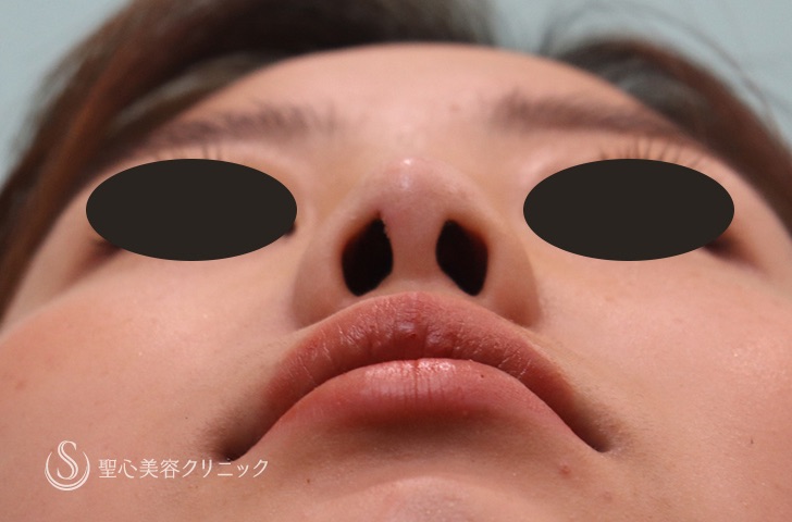 【20代女性・鼻筋を通したい】鼻のプロテーゼ（1週間後） After 
