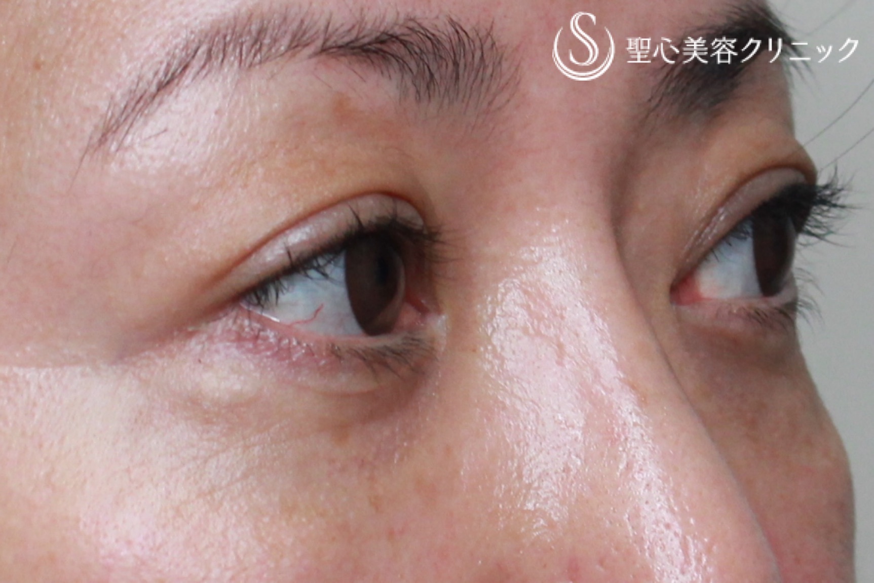 【40代女性・目周りの若返り】眼瞼下垂(切開法)＋経結膜下脱脂術（1ヶ月後） After 