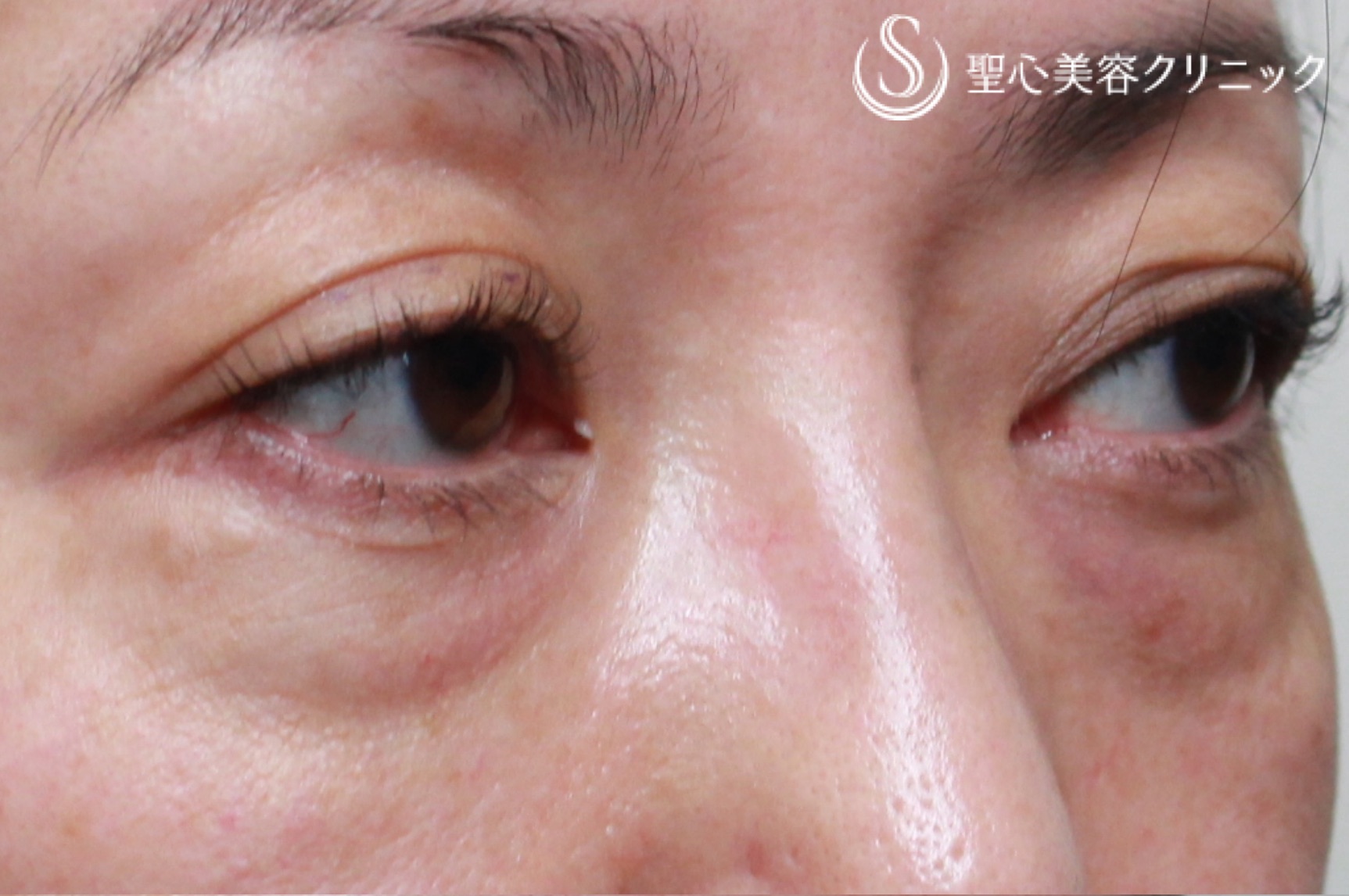 【40代女性・目周りの若返り】眼瞼下垂(切開法)＋経結膜下脱脂術（1ヶ月後） Before 