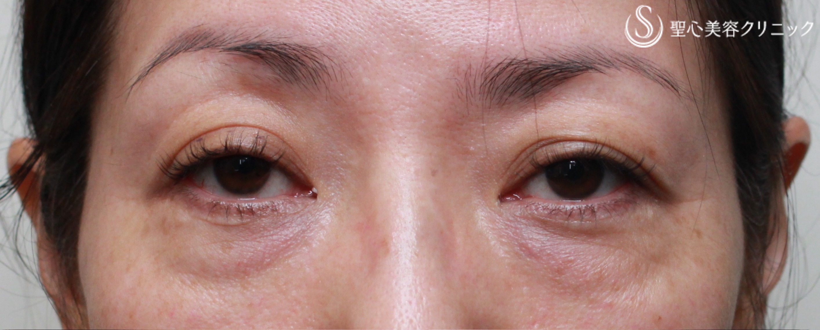 【40代女性・目周りの若返り】眼瞼下垂(切開法)＋経結膜下脱脂術（1ヶ月後） Before 