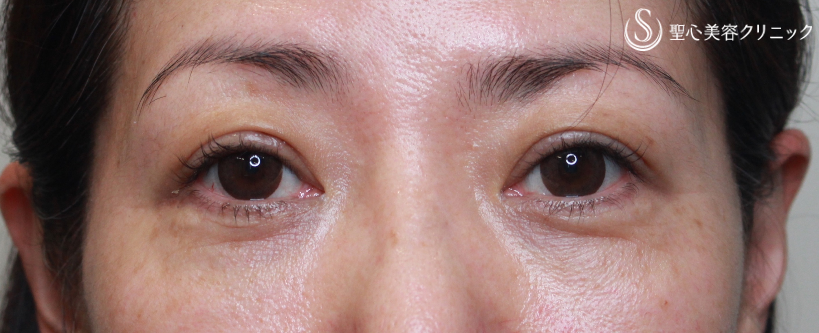 【40代女性・目周りの若返り】眼瞼下垂(切開法)＋経結膜下脱脂術（1ヶ月後） After 