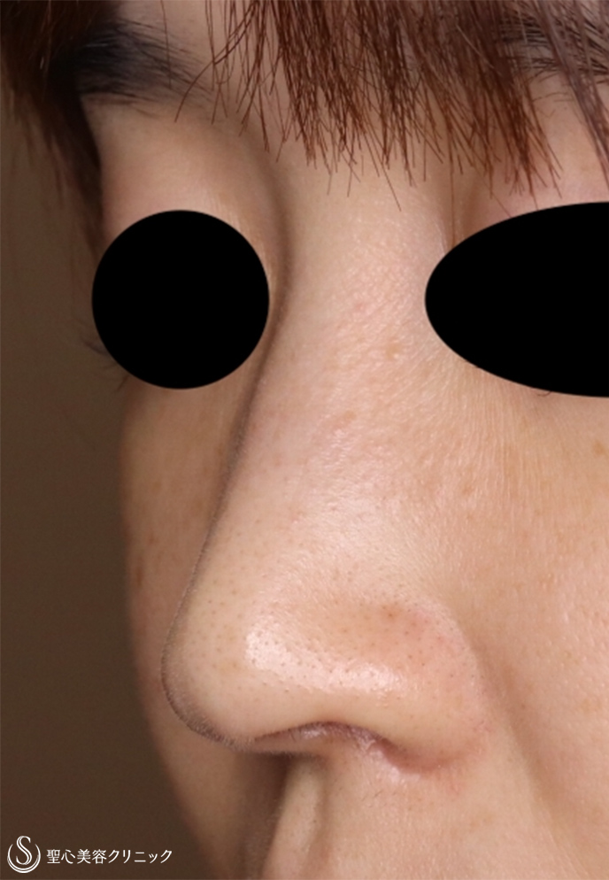 【30代女性・鼻の穴を目立ちにくく】鼻孔縁下降術（術後1ヶ月） After 