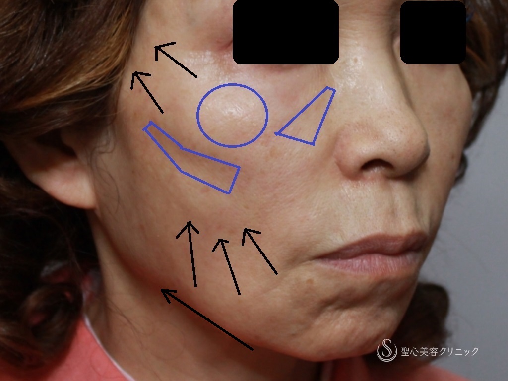 【60代女性・こめかみ、頬、フェイスライン、顎下のたるみ改善】アンカーDXダブル+頬ヒアルロン酸（直後、1週間後比較） Before 