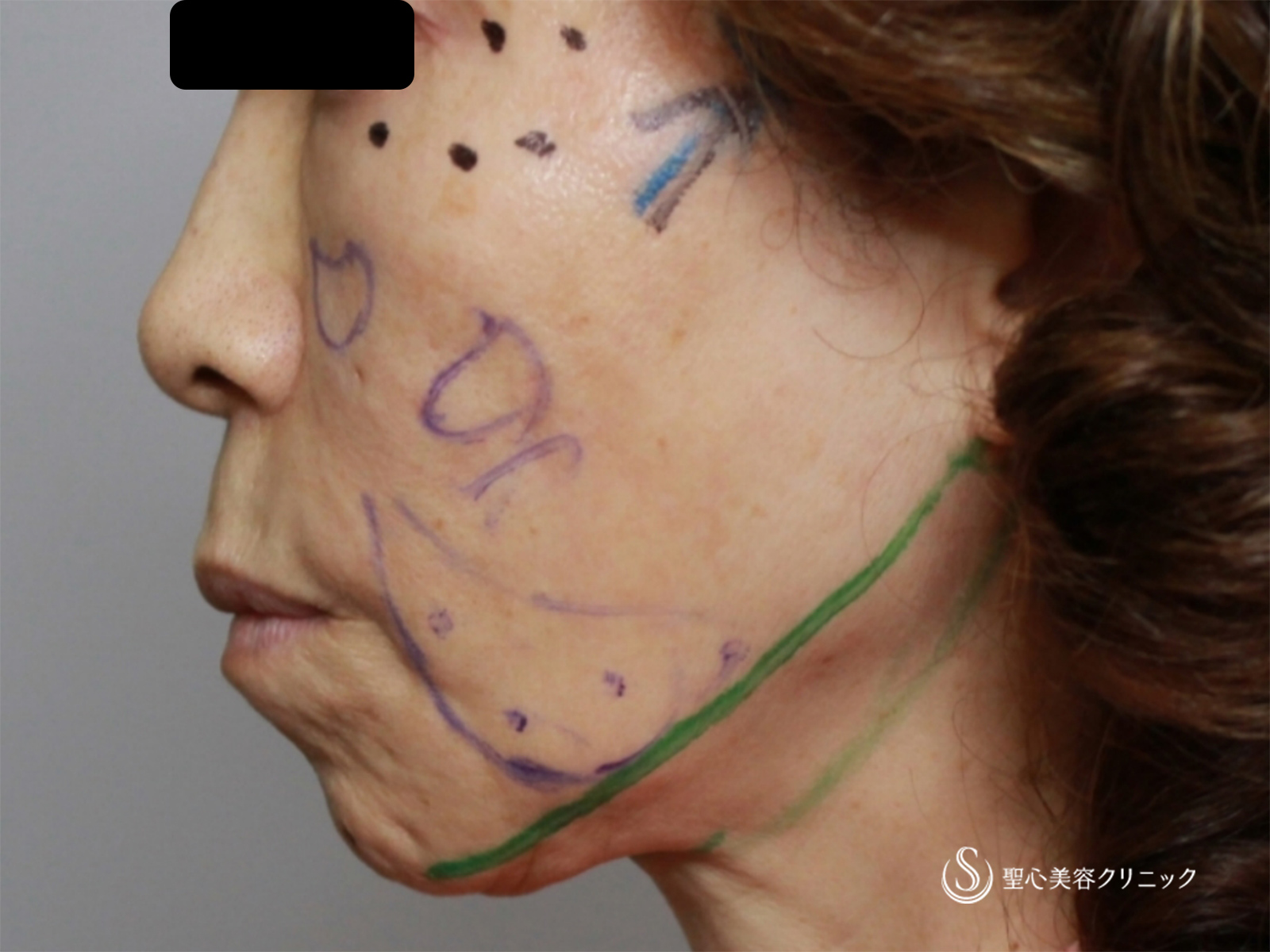 【60代女性・こめかみ、頬、フェイスライン、顎下のたるみ改善】アンカーDXダブル+頬ヒアルロン酸（直後、1週間後比較） Before 