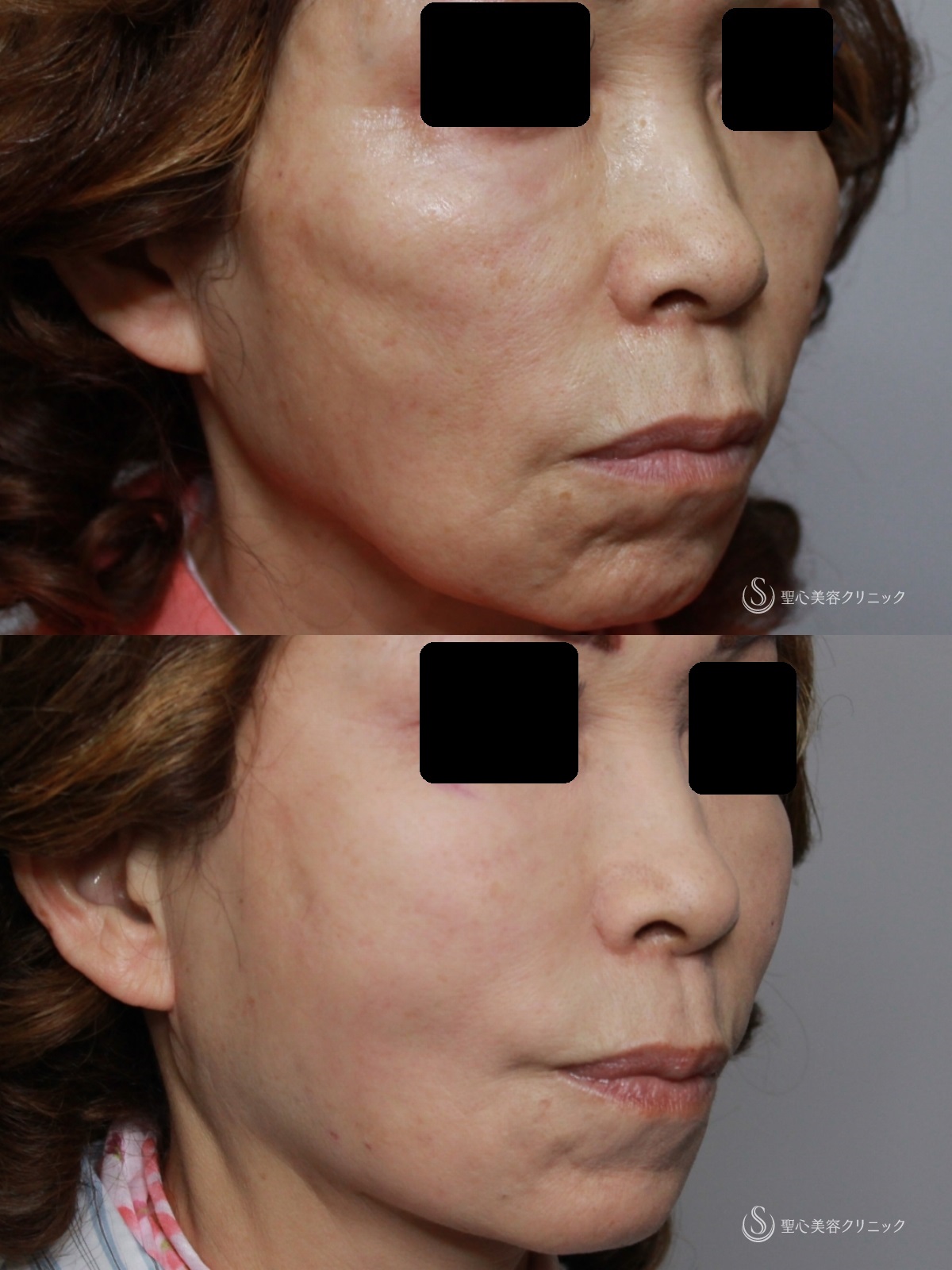 【60代女性・こめかみ、頬、フェイスライン、顎下のたるみ改善】アンカーDXダブル+頬ヒアルロン酸（直後、1週間後比較） After 