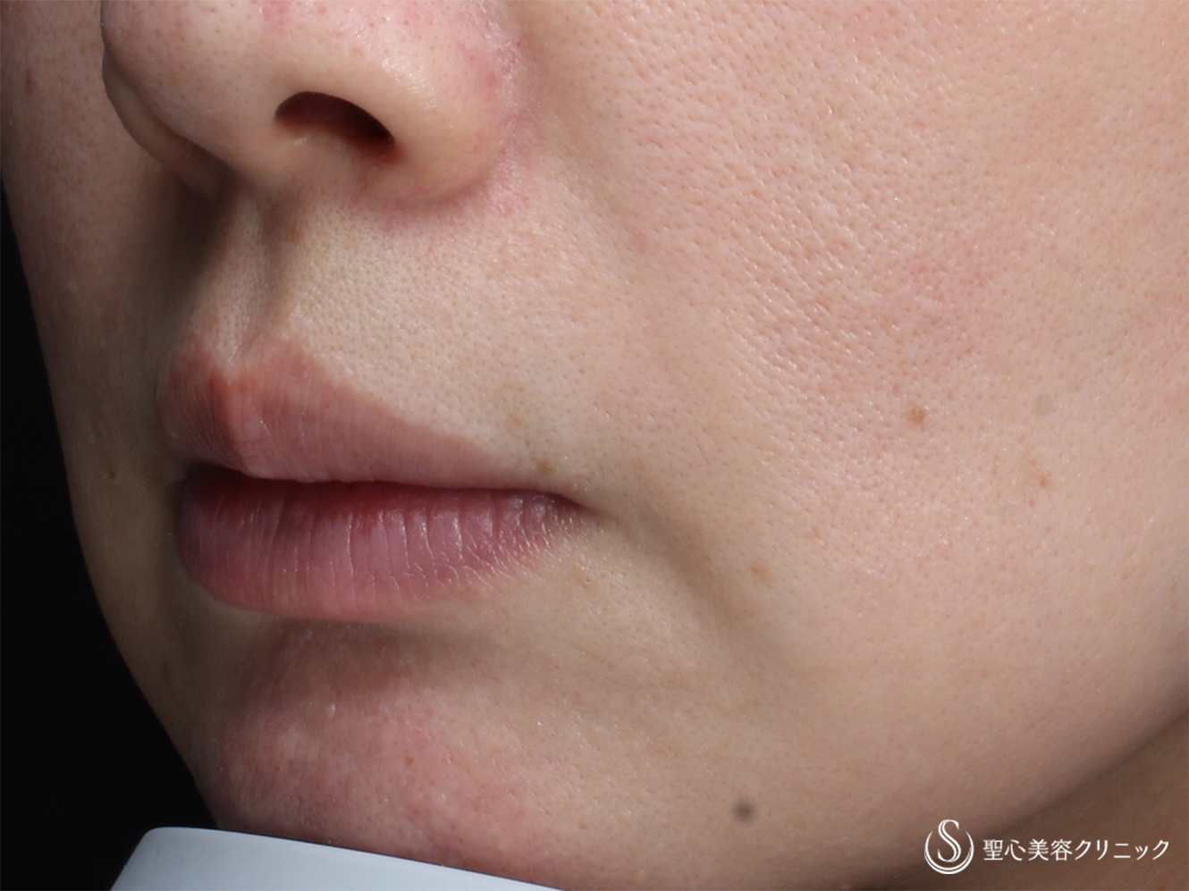 【40代女性・顎のニキビ跡の赤み改善】585 - Quanta System Ｑ1モニター（2回処置後） Before 