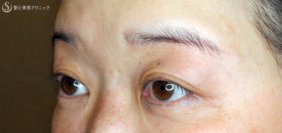 【40代女性・同じ糸で眼瞼下垂と二重（長期経過）＆瞼のタルミ】切らない眼瞼下垂+α法（6年後）眉下リフト（6ヶ月後） After 