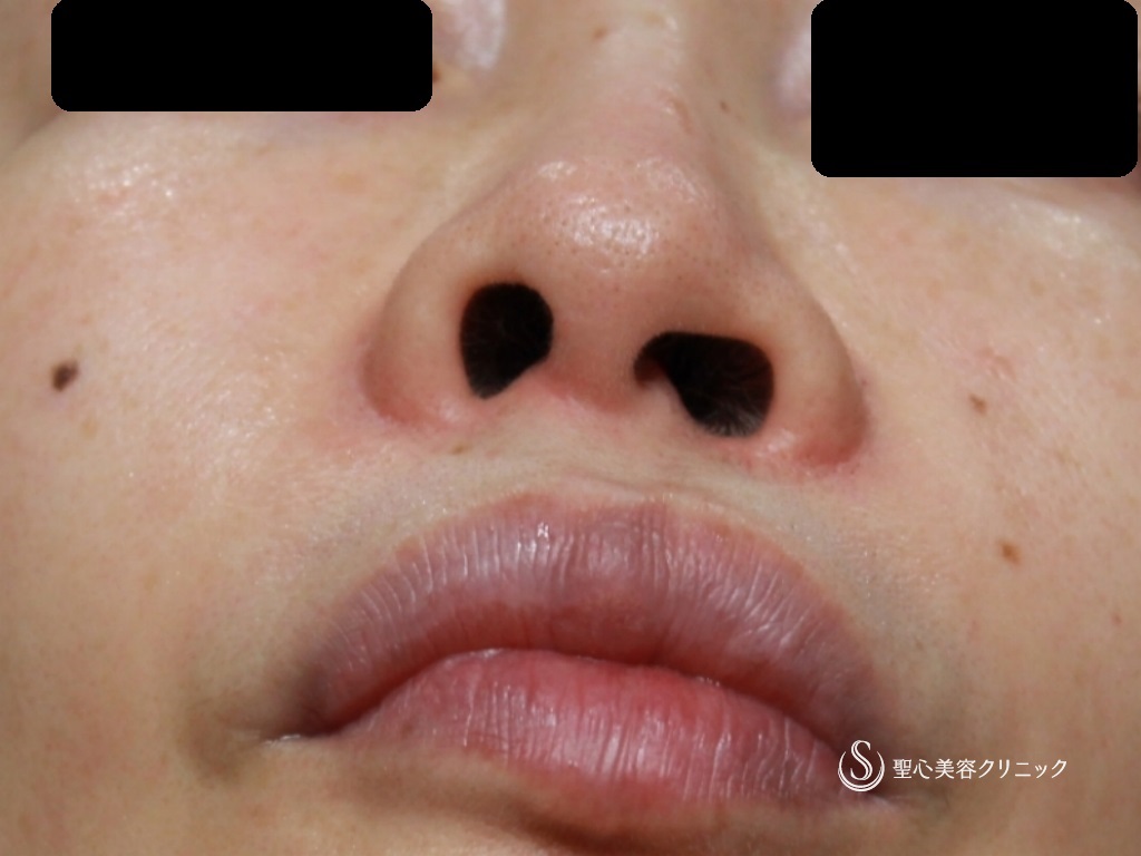 【50代女性・生まれつきの鼻の左右差の修正】左小鼻縮小+鼻尖縮小+３DPCLドーム+鼻柱矯正（オープン法）（1ヶ月後） Before 