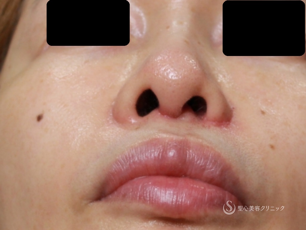 【50代女性・生まれつきの鼻の左右差の修正】左小鼻縮小+鼻尖縮小+３DPCLドーム+鼻柱矯正（オープン法）（1ヶ月後） After 