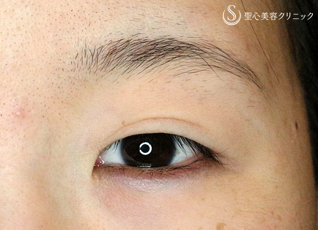 【20代女性・他院修正で自然な末広型二重】二重全切開+α法「Ver.4」（4年後） Before 