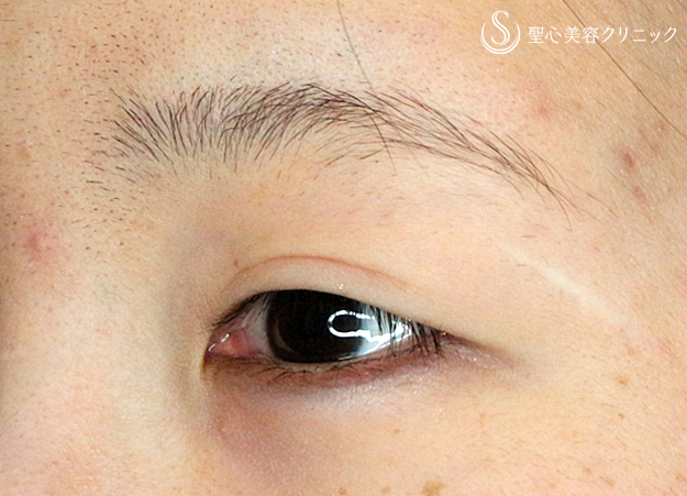 【20代女性・他院修正で自然な末広型二重】二重全切開+α法「Ver.4」（4年後） Before 