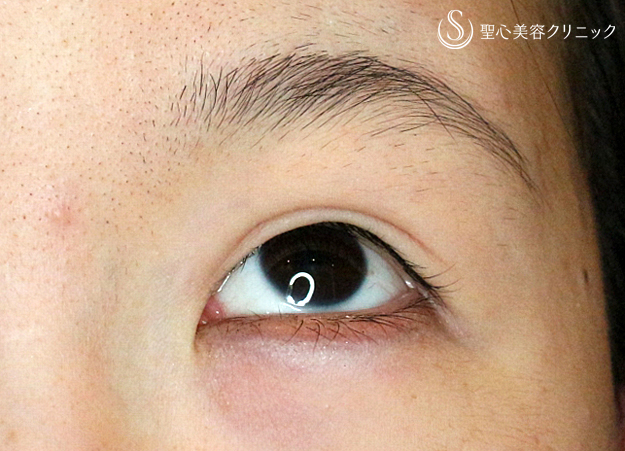 【20代女性・他院修正で自然な末広型二重】二重全切開+α法「Ver.4」（4年後） Before 