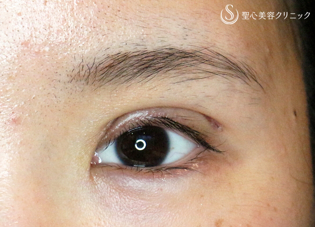 【20代女性・他院修正で自然な末広型二重】二重全切開+α法「Ver.4」（4年後） After 