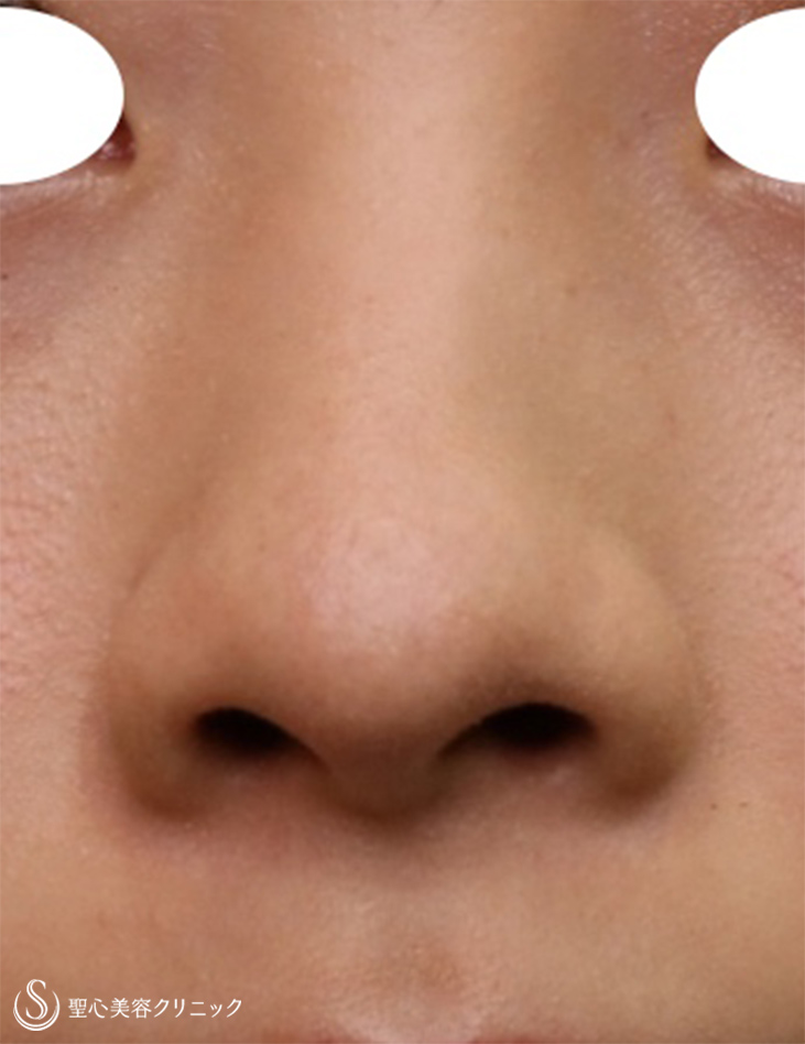 【20代女性・鼻先をスッキリ】鼻尖縮小＋耳介軟骨移植（1ヵ月後） Before 