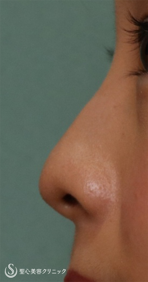 【20代女性・鼻先をスッキリ】鼻尖縮小＋耳介軟骨移植（1ヵ月後） Before 