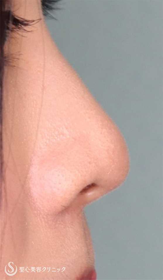 【20代女性・鼻先をスッキリ】鼻尖縮小＋耳介軟骨移植（1ヵ月後） After 