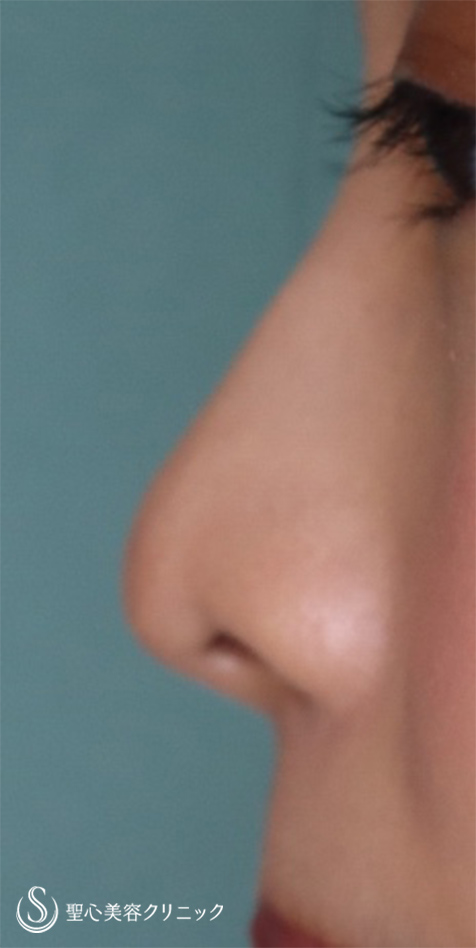 【20代女性・鼻先をスッキリ】鼻尖縮小＋耳介軟骨移植（1ヵ月後） After 