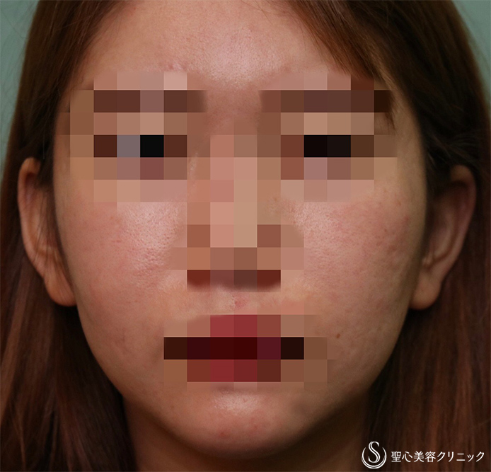 【20代女性・患者様の本来の美しさを最大限に引き出す】フェイスリフト手術（術後3か月） Before 