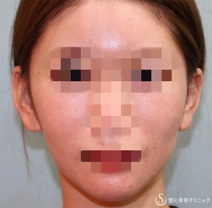 【20代女性・患者様の本来の美しさを最大限に引き出す】フェイスリフト手術（術後3か月） After 