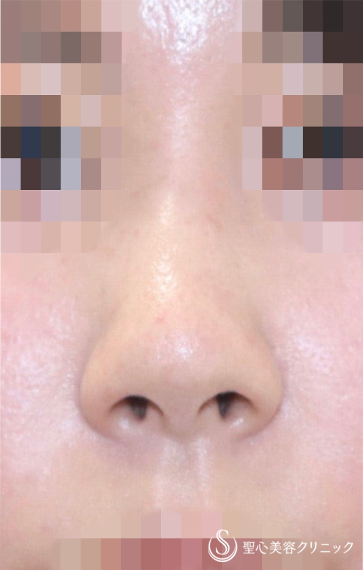 代女性 団子鼻 鼻の穴を目立たなく 鼻尖縮小術 小鼻縮小術 術後1週間 症例写真 美容整形 美容外科なら聖心美容クリニック
