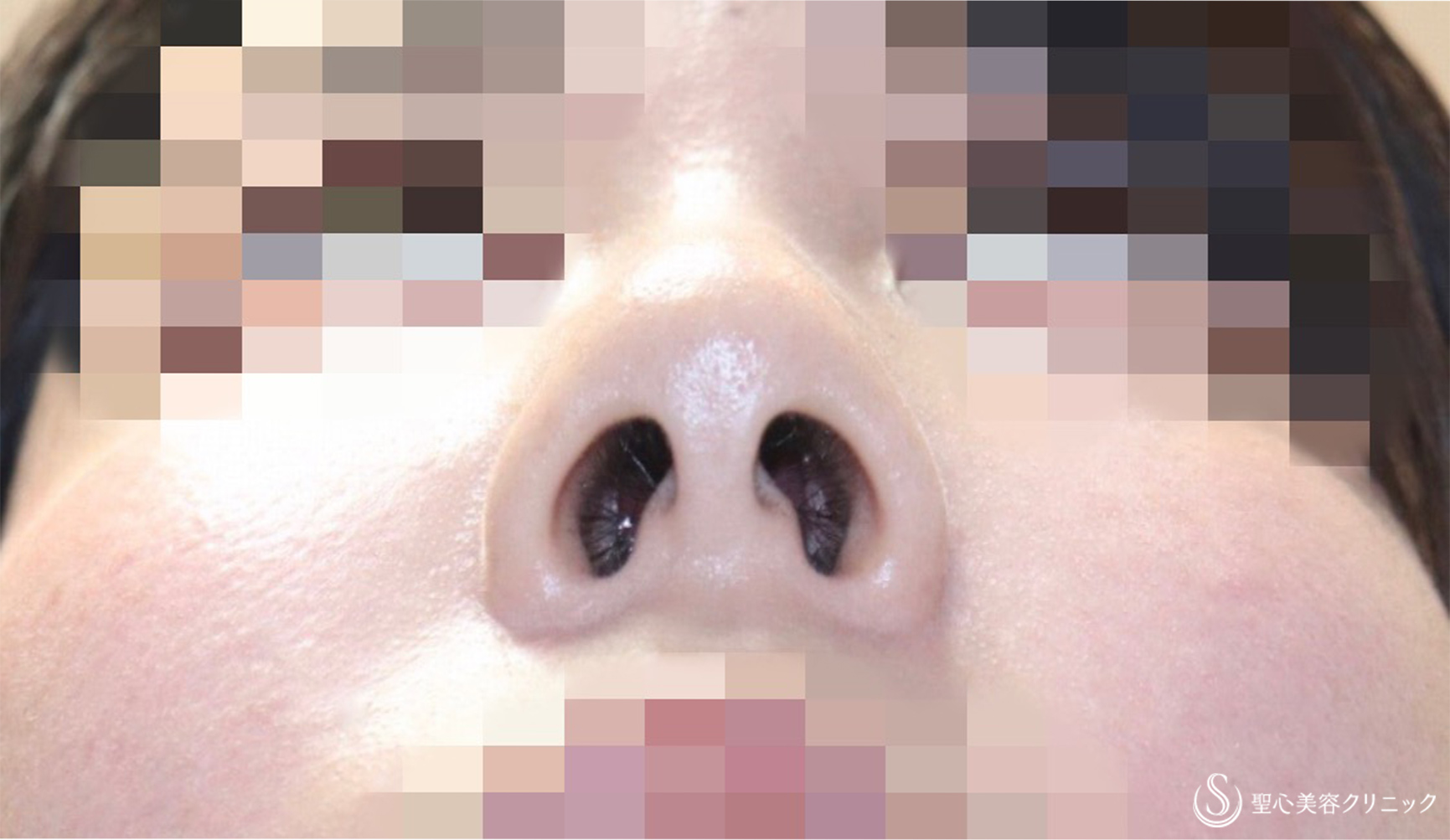 【20代女性・団子鼻＆鼻の穴を目立たなく】鼻尖縮小術＆小鼻縮小術（術後1週間） 症例写真 美容整形、美容外科なら聖心美容クリニック