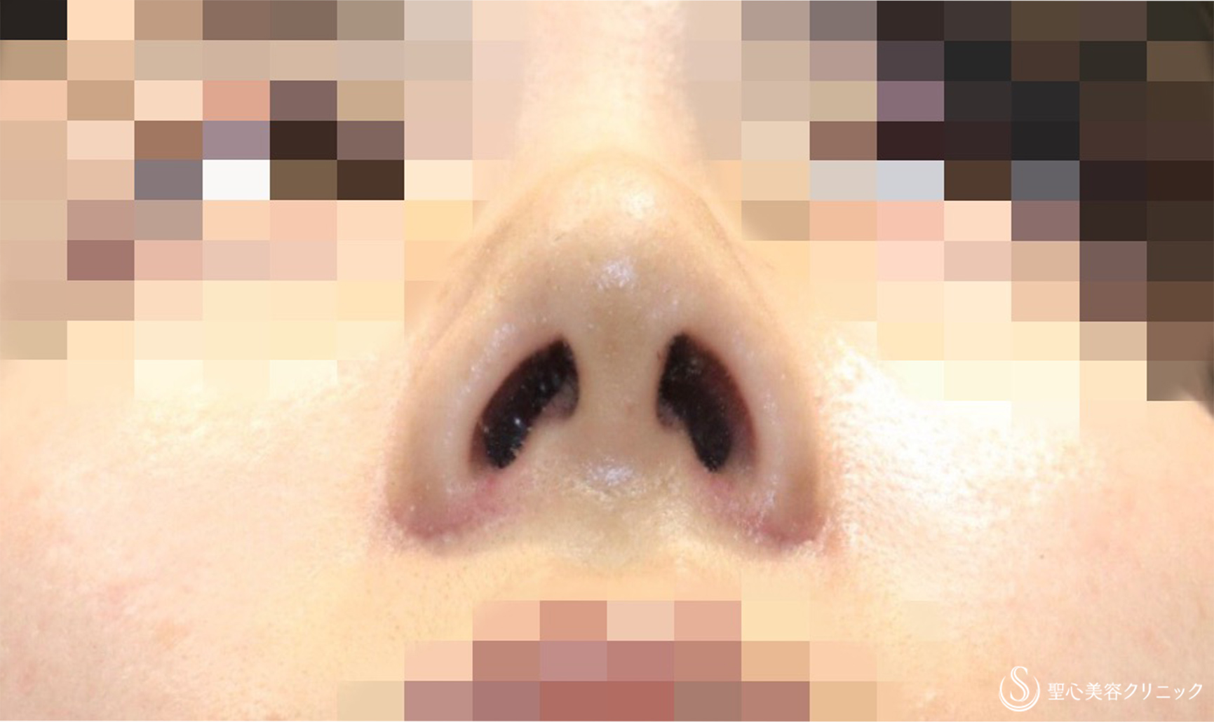 【20代女性・団子鼻＆鼻の穴を目立たなく】鼻尖縮小術＆小鼻縮小術（術後1週間） 症例写真 美容整形、美容外科なら聖心美容クリニック