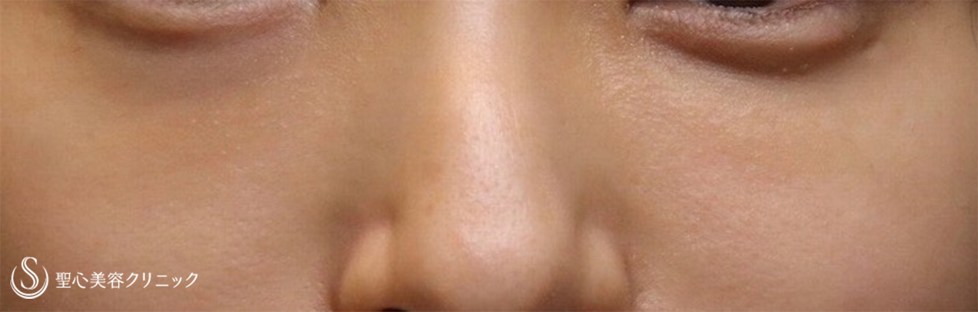【20代女性・注入治療だけで目の下のクマ改善】プレミアムPRP皮膚再生療法 （6ヶ月後） After 