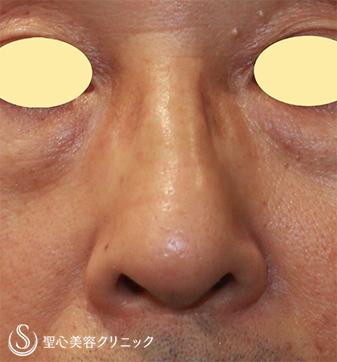 【50代男性・鼻の凹みを改善】 鼻尖縮小（術後１ヶ月） After 