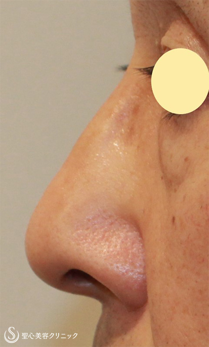 【50代男性・鼻の凹みを改善】 鼻尖縮小（術後１ヶ月） After 