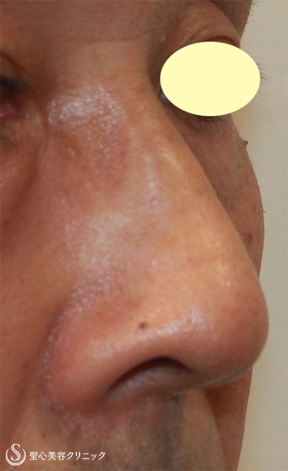 【50代男性・鼻の凹みを改善】 鼻尖縮小（術後１ヶ月） After 