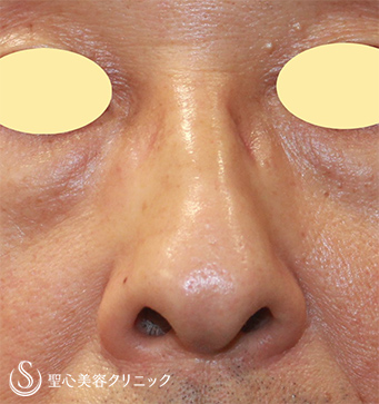 【50代男性・鼻の凹みを改善】 鼻尖縮小（術後１ヶ月） Before 