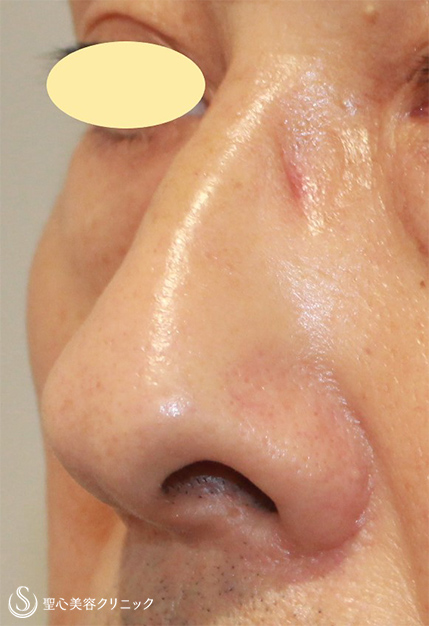 【50代男性・鼻の凹みを改善】 鼻尖縮小（術後１ヶ月） Before 