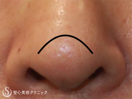 【50代男性・鼻の凹みを改善】 鼻尖縮小（術後１ヶ月） After 