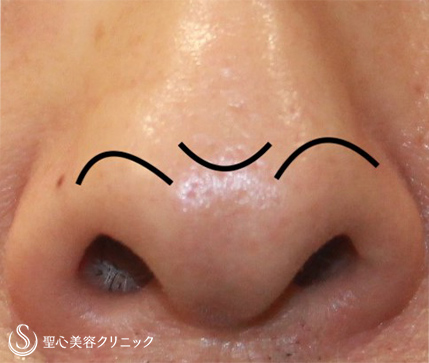 【50代男性・鼻の凹みを改善】 鼻尖縮小（術後１ヶ月） Before 