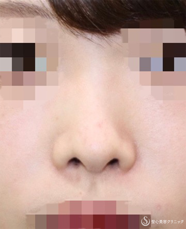 【20代女性・鼻の穴を目立たなく＆鼻筋をスッと】鼻孔縁下降術＋Gメッシュ（術後2週） Before 
