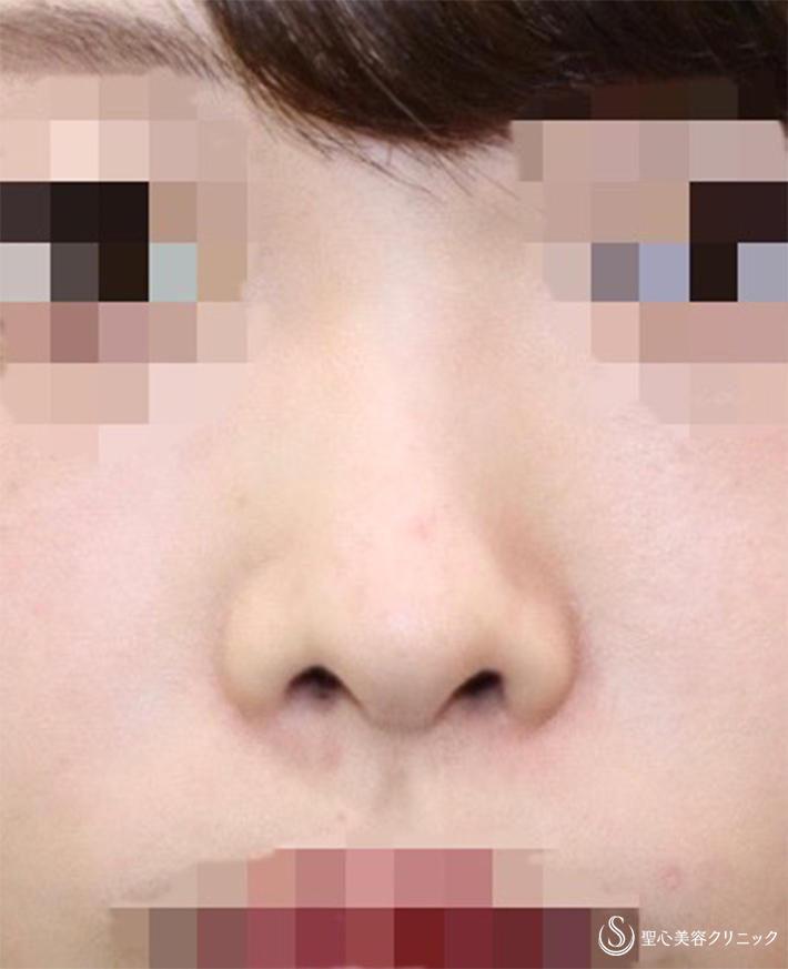 代女性 鼻の穴を目立たなく 鼻筋をスッと 鼻孔縁下降術 Gメッシュ 術後2週 症例写真 美容整形 美容外科なら聖心美容クリニック